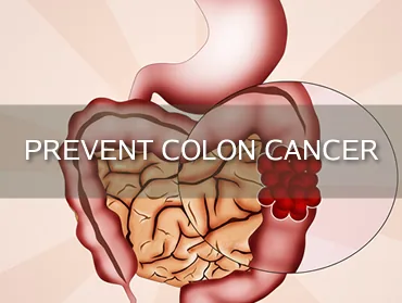 Illustration from Top 12 Steps You Can Take to Prevent Colon Cancer Today!